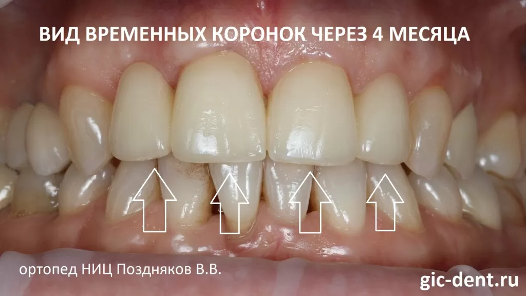 Так выглядят временные коронки на 4 верхних перелних зубах через 4 месяца после установки. Имплантация - Колушев Г.В., отопедия - Поздняков В.В. 